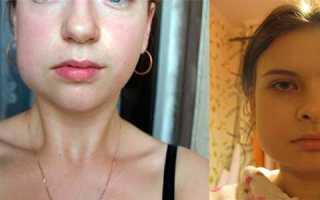 Опухла щека после укола лидокаина