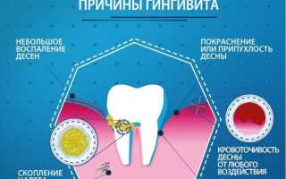 Пародонтоз, гингивит и пародонтит, что их объединяет?