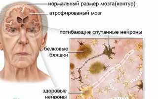 Почему происходит отмирание клеток головного мозга и каковы последствия атрофии
