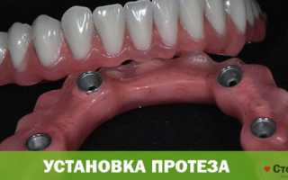 Съемные зубные протезы
