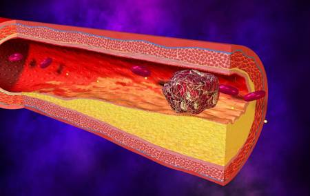 Артериальные тромбозы