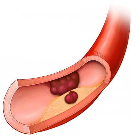 Сосудистый тромбоз после приема алкоголя и противозачаточных