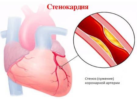 Хлое при стенокардии