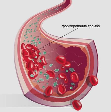 Противопоказания для ведения Депо-Провера