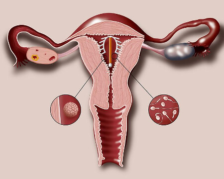 Установка внутриматочной спирали после отмены ОК