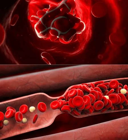 Противозачаточные таблетки при тромбозе