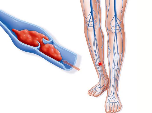 Противозачаточные при тромбозах