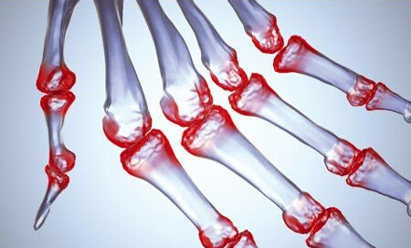 Контрацептивы при ревматоидном артрите