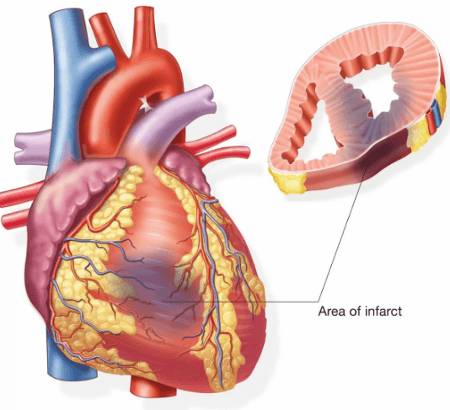 Прием таблеток после инфаркта