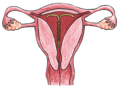 Правильно установленная спираль в матке