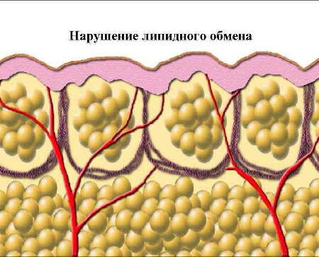 Нарушение липидного обмена в организме