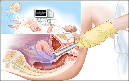 Трансвагинальное узи для женщины