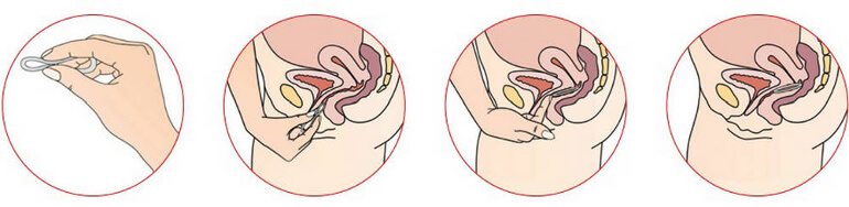 Инструкция по установке кольца Новаринг