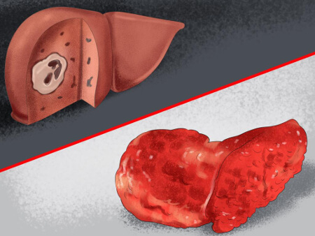 Контрацептивы с левоноргестрелом при печеночной недостаточности