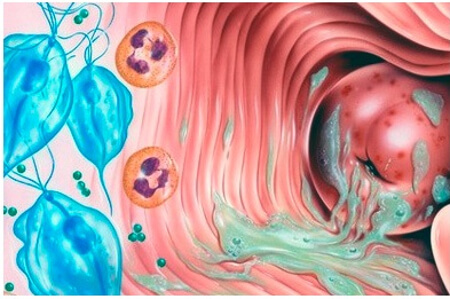 Спринцевание при воспалительном процессе во влагалище