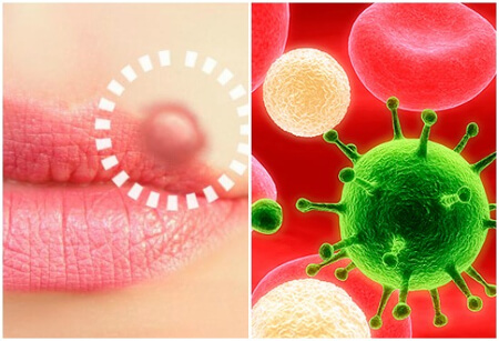 Свечи Фарматекс при вирусе герпеса