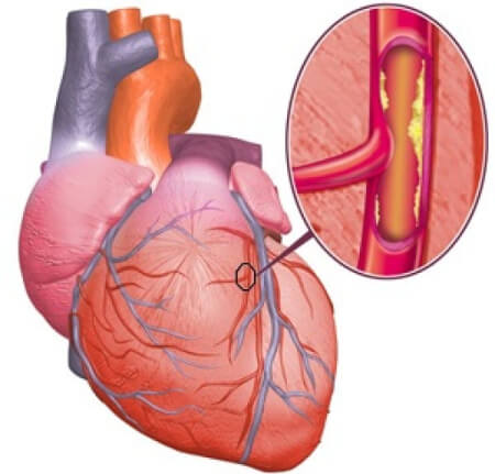 Прием гормональных средств при ишемической болезни сердца