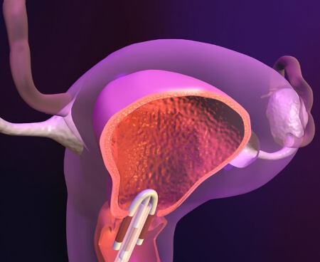 Инфекционный процесс после установки вмс