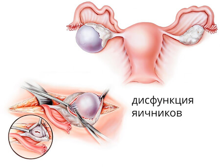 Противопоказания для вагинальной спирали