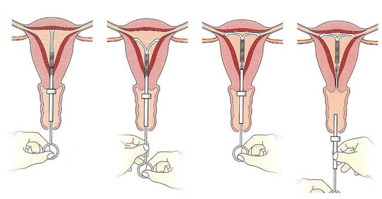 Схема установки для ВМС Т-образной формы