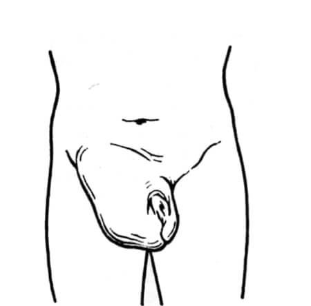 Паховая грыжа у мужчины