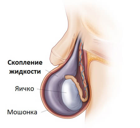 Скопление жидкости в яичке после вазэктомии