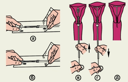 Пошаговая установка противозачаточной спирали Мирена