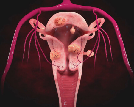 Внутриматочная спираль при миоме