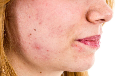 Появление акне после установки спирали