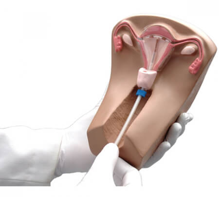 Установка спирали Мультиплоад