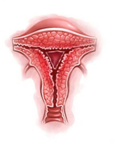 Установка спирали Юнона при гиперплазии эндометрия