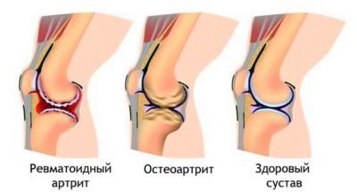 артрит